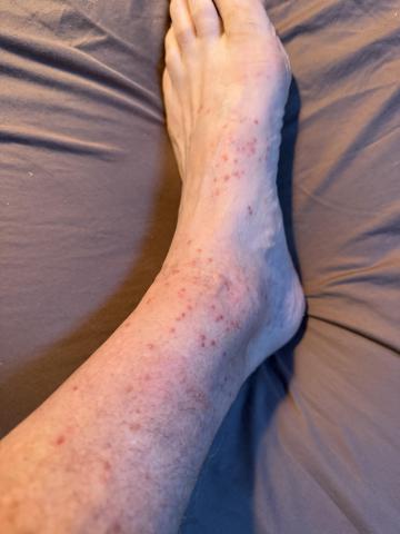 Chiggers in large numbers can create hundreds of itchy red welts. 